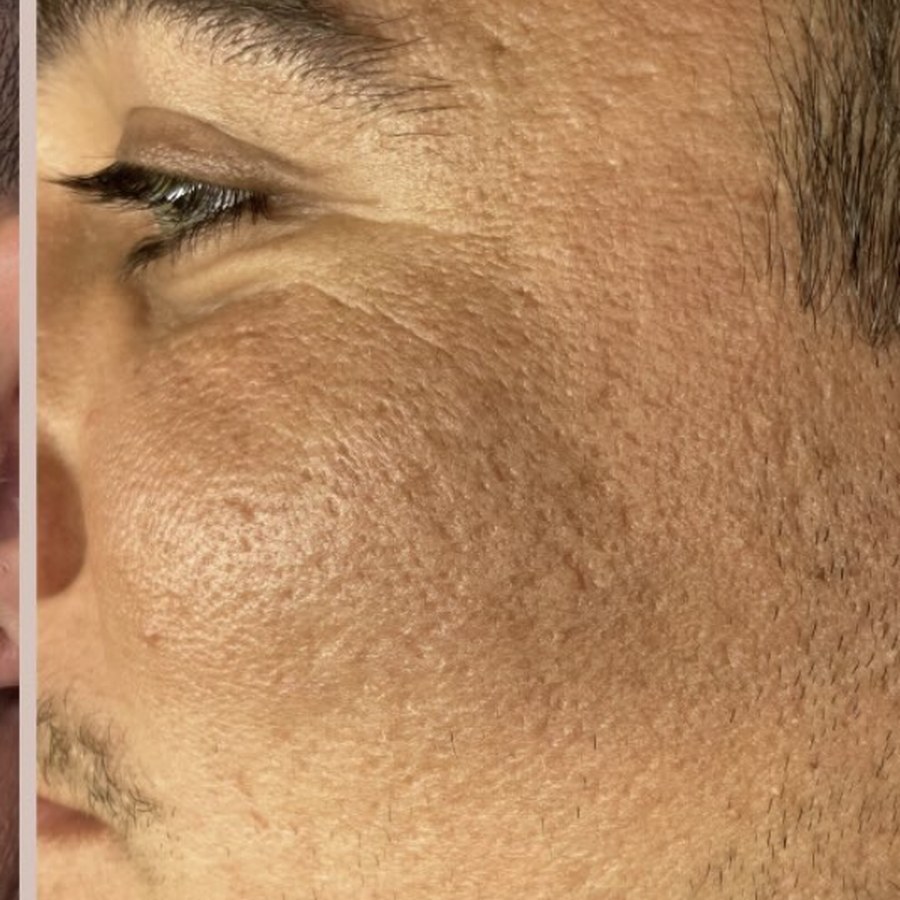 Pele com marcas de acne atenuadas depois do microagulhamento