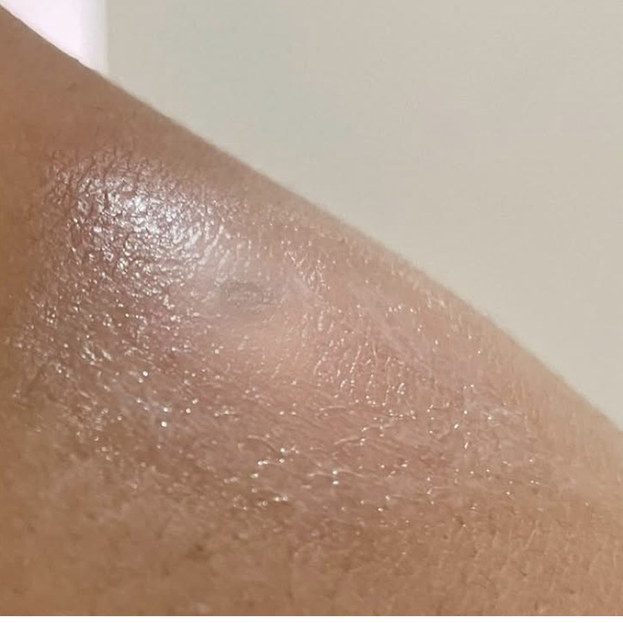 Região depois da remoção de sinal com jato de plasma