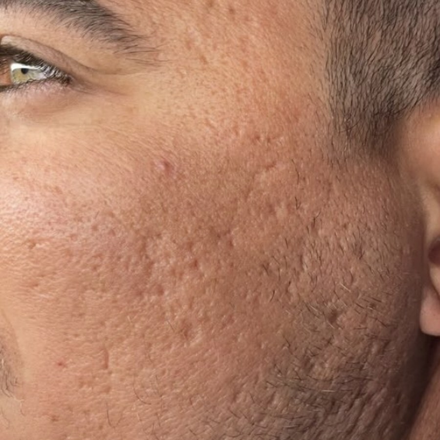 Pele com marcas de acne antes do microagulhamento