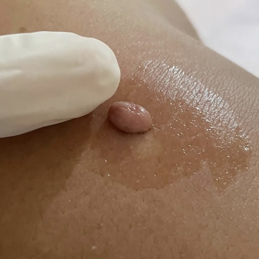 Região antes da remoção de sinal com jato de plasma